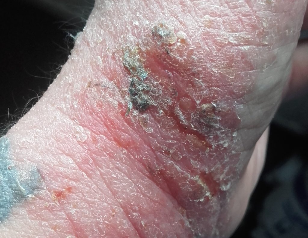 A woman who quit her eczema steroid creams says she felt boiled alive - her skin turned beetroot red, oozed and left her housebound and screaming for months.