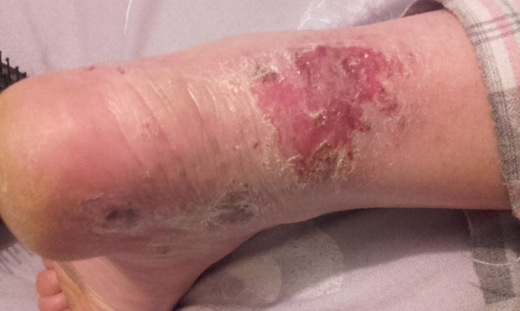 A woman who quit her eczema steroid creams says she felt boiled alive - her skin turned beetroot red, oozed and left her housebound and screaming for months.