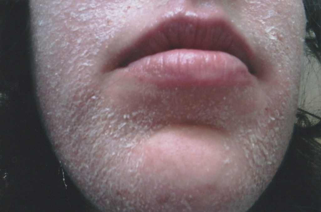 A woman who quit her eczema steroid creams says she felt boiled alive - her skin turned beetroot red, oozed and left her housebound and screaming for months.