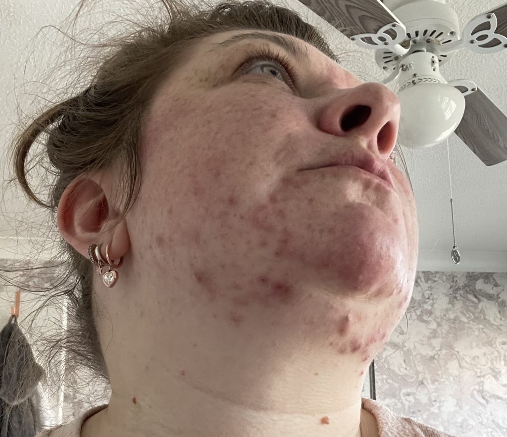 Teaching assistant Fi Styles called in sick after pupils mocked her acne - then a £16 serum cleared her skin completely in six months.