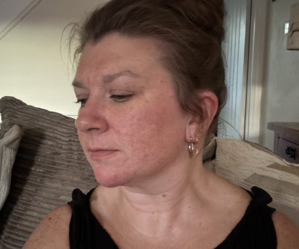 Teaching assistant Fi Styles called in sick after pupils mocked her acne - then a £16 serum cleared her skin completely in six months.