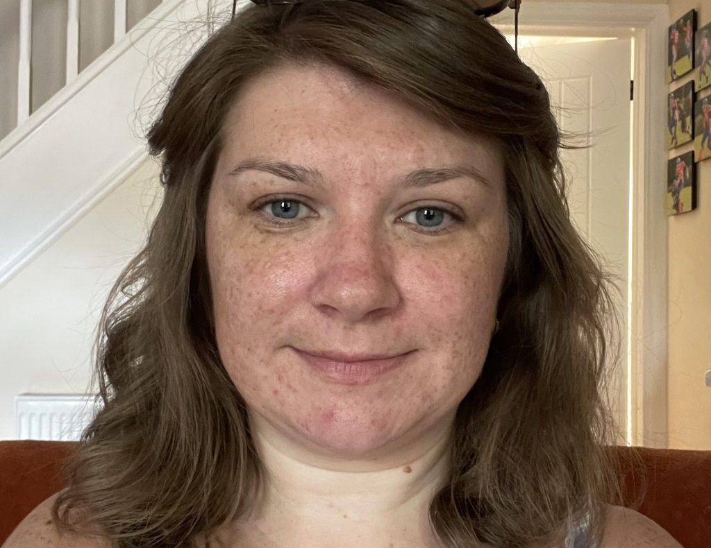 Teaching assistant Fi Styles called in sick after pupils mocked her acne - then a £16 serum cleared her skin completely in six months.