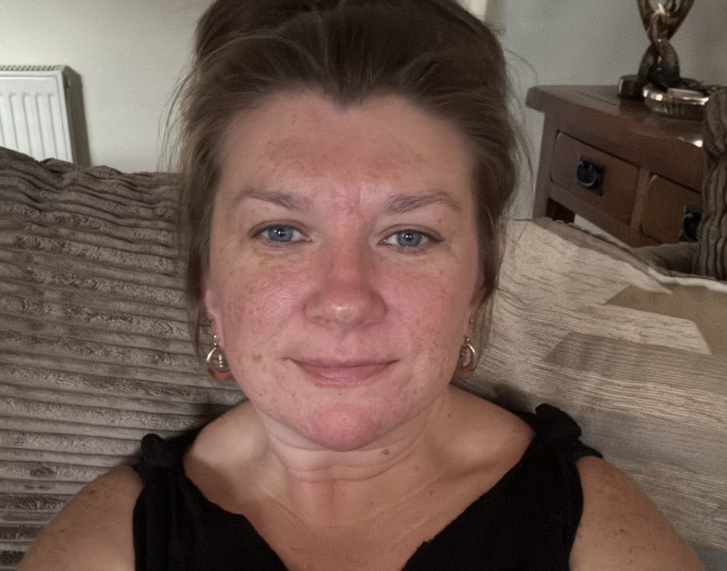 Teaching assistant Fi Styles called in sick after pupils mocked her acne - then a £16 serum cleared her skin completely in six months.