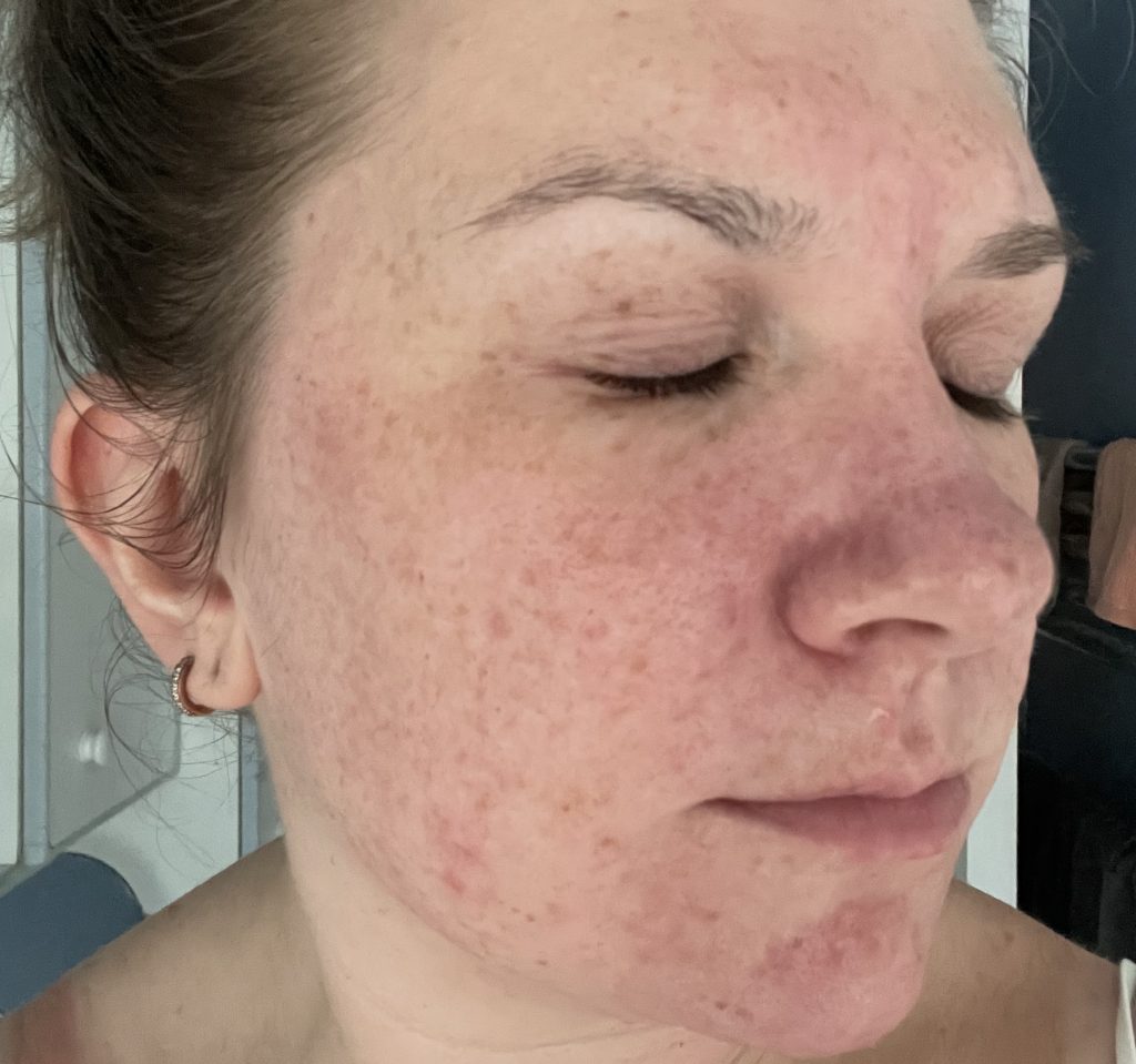 Teaching assistant Fi Styles called in sick after pupils mocked her acne - then a £16 serum cleared her skin completely in six months.