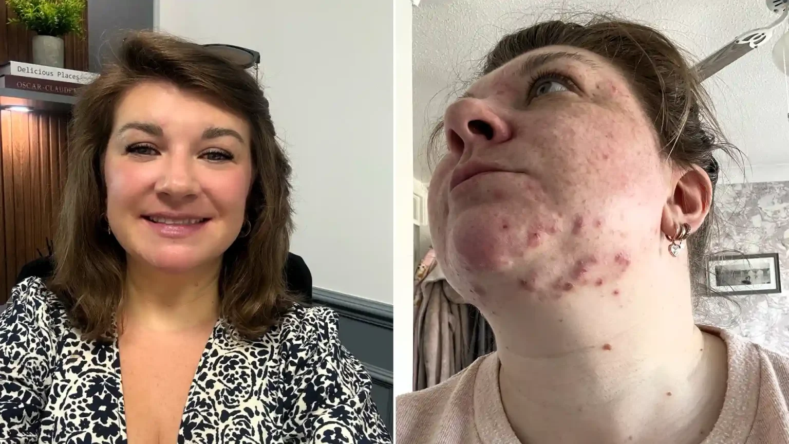 Teaching assistant Fi Styles called in sick after pupils mocked her acne - then a £16 serum cleared her skin completely in six months.