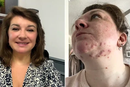 Teaching assistant Fi Styles called in sick after pupils mocked her acne - then a £16 serum cleared her skin completely in six months.