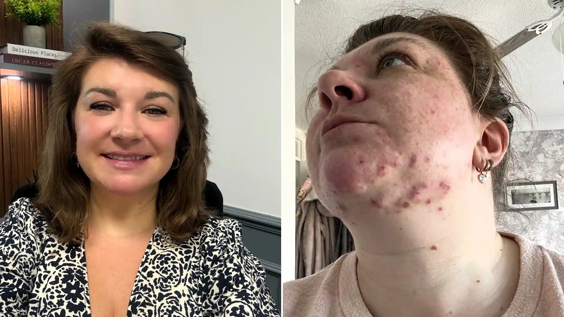 Teaching assistant Fi Styles called in sick after pupils mocked her acne - then a £16 serum cleared her skin completely in six months.