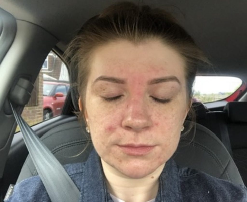 Teaching assistant Fi Styles called in sick after pupils mocked her acne - then a £16 serum cleared her skin completely in six months.