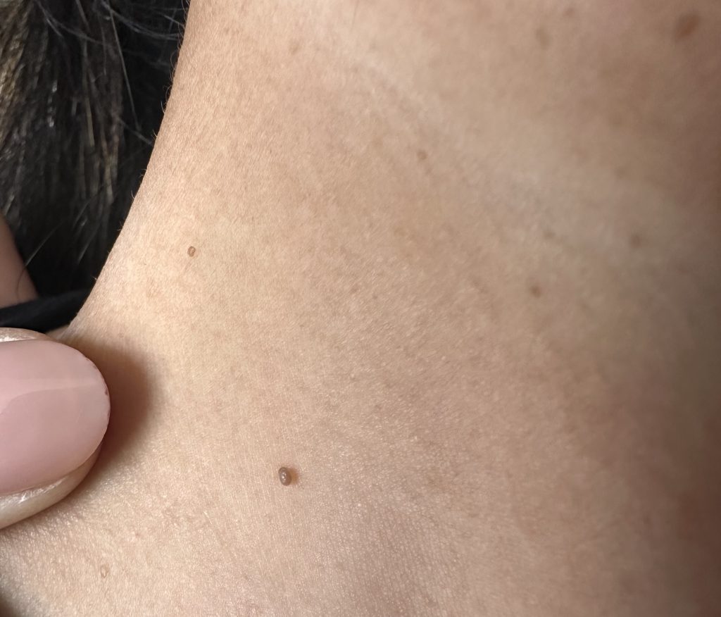 Doctors told scientist Janet Peets her skin tags were just cosmetic - but they were a warning sign of a hidden liver disease she says she has now reversed herself.