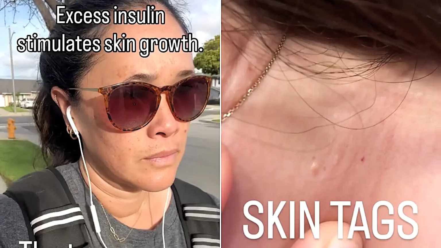 Doctors told scientist Janet Peets her skin tags were just cosmetic - but they were a warning sign of a hidden liver disease she says she has now reversed herself.
