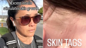 Doctors told scientist Janet Peets her skin tags were just cosmetic - but they were a warning sign of a hidden liver disease she says she has now reversed herself.