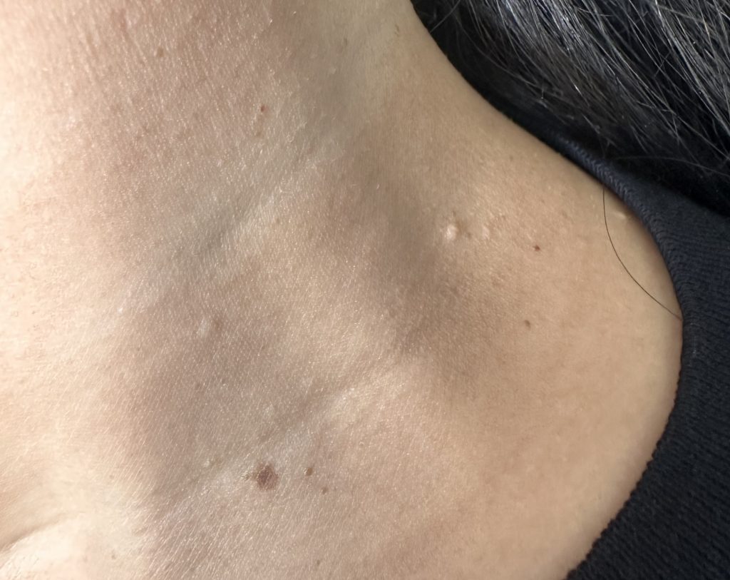 Doctors told scientist Janet Peets her skin tags were just cosmetic - but they were a warning sign of a hidden liver disease she says she has now reversed herself.