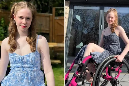 A woman had her leg amputated at 20 after pain that felt like burning alive left her unable to leave the house for eight months - and says it was worth it.