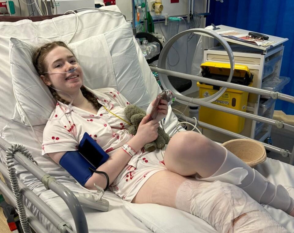 A woman had her leg amputated at 20 after pain that felt like burning alive left her unable to leave the house for eight months - and says it was worth it.