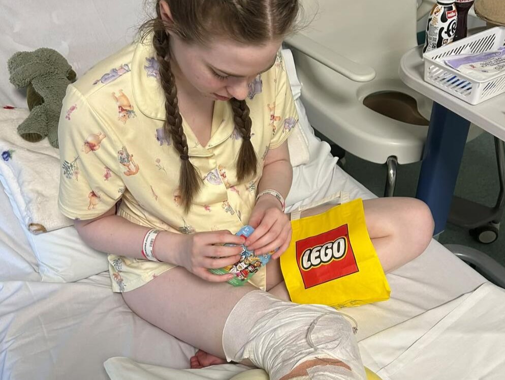 A woman had her leg amputated at 20 after pain that felt like burning alive left her unable to leave the house for eight months - and says it was worth it.