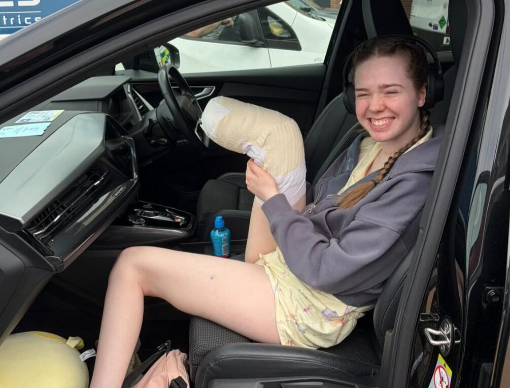 A woman had her leg amputated at 20 after pain that felt like burning alive left her unable to leave the house for eight months - and says it was worth it.