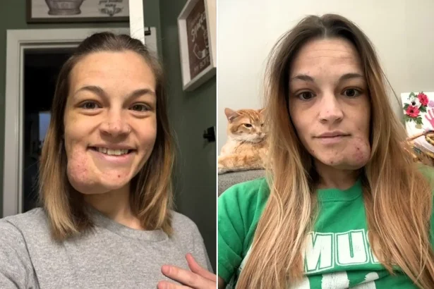 A woman's puberty 'pimple' turned out to be a permanent blood clot on her face that has grown for 19 years - and she can feel her pulse throbbing through it.