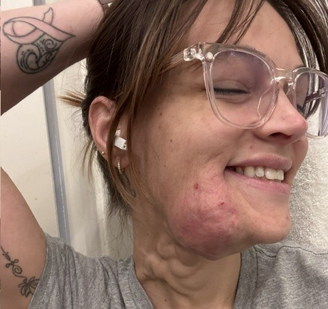 A woman's puberty 'pimple' turned out to be a permanent blood clot on her face that has grown for 19 years - and she can feel her pulse throbbing through it.