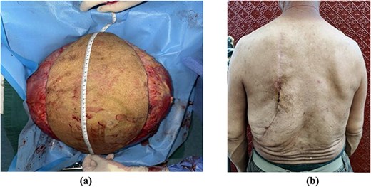 A pensioner had a 22lb lump the weight of three newborn babies removed from his back - after it lurked for three decades before suddenly ballooning in size.