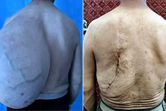 A pensioner had a 22lb lump the weight of three newborn babies removed from his back - after it lurked for three decades before suddenly ballooning in size.