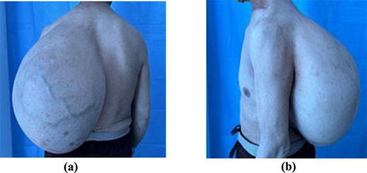 A pensioner had a 22lb lump the weight of three newborn babies removed from his back - after it lurked for three decades before suddenly ballooning in size.