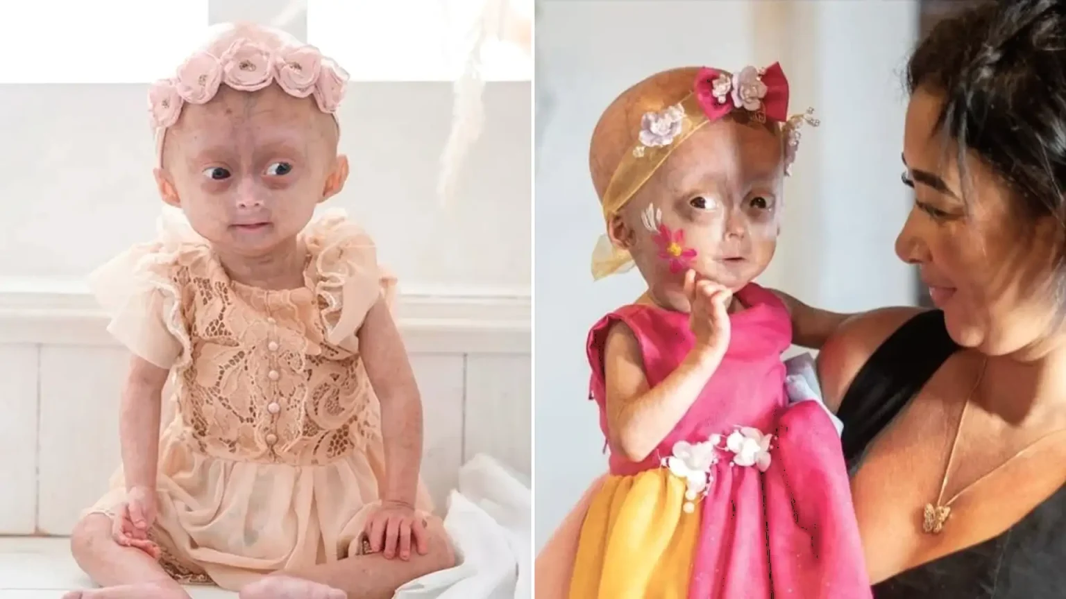 A five-year-old social media star believed to be one of the world's only twins with a rare rapid ageing syndrome has died, her family announced to 1m Instagram followers.