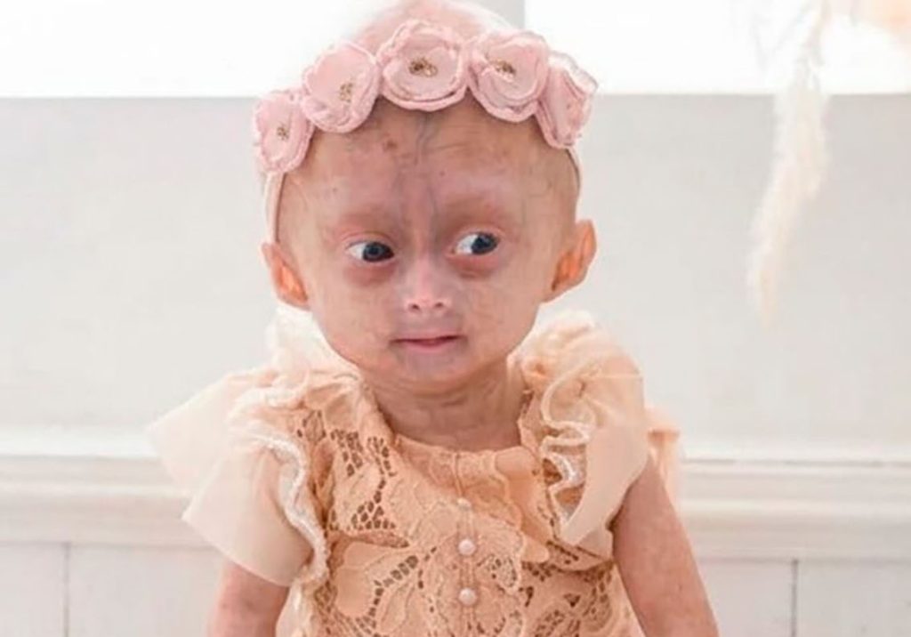 A five-year-old social media star believed to be one of the world's only twins with a rare rapid ageing syndrome has died, her family announced to 1m Instagram followers.