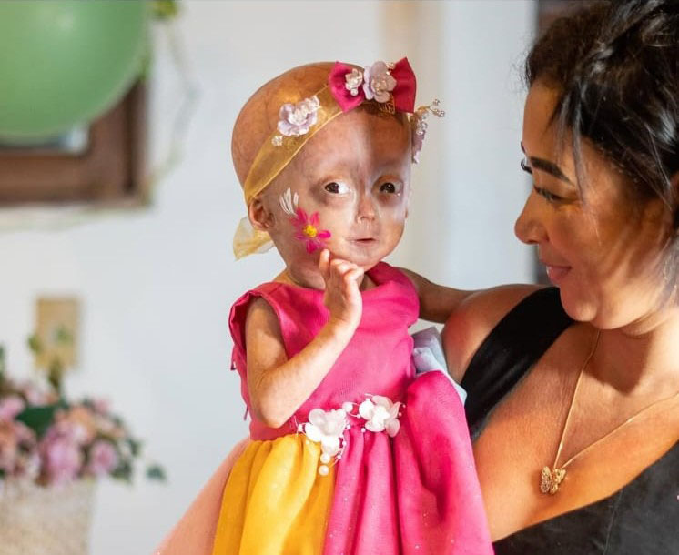 A five-year-old social media star believed to be one of the world's only twins with a rare rapid ageing syndrome has died, her family announced to 1m Instagram followers.
