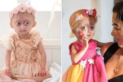 A five-year-old social media star believed to be one of the world's only twins with a rare rapid ageing syndrome has died, her family announced to 1m Instagram followers.