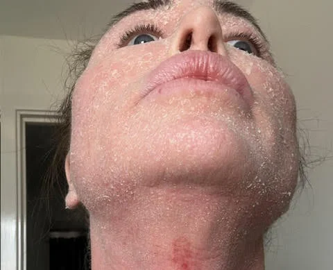 Ex on the Beach star warns of topical steroid withdrawal after spending £380k on cosmetic surgery left her severely disfigured and bedbound for weeks at a time.