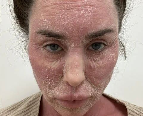 Ex on the Beach star warns of topical steroid withdrawal after spending £380k on cosmetic surgery left her severely disfigured and bedbound for weeks at a time.