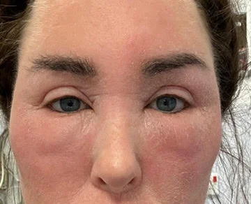 Ex on the Beach star warns of topical steroid withdrawal after spending £380k on cosmetic surgery left her severely disfigured and bedbound for weeks at a time.