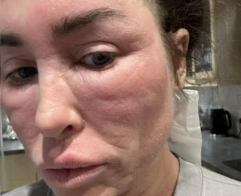 Ex on the Beach star warns of topical steroid withdrawal after spending £380k on cosmetic surgery left her severely disfigured and bedbound for weeks at a time.