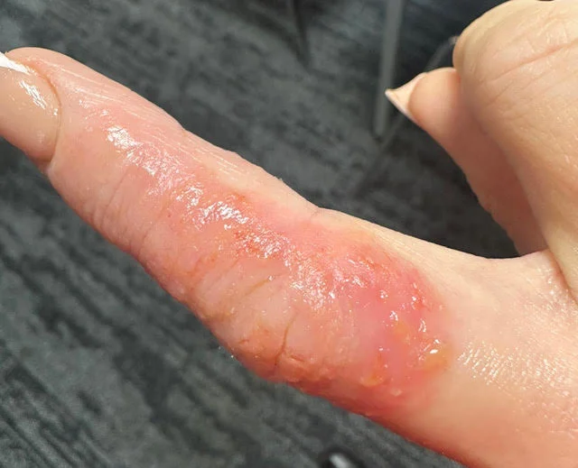 Ex on the Beach star warns of topical steroid withdrawal after spending £380k on cosmetic surgery left her severely disfigured and bedbound for weeks at a time.