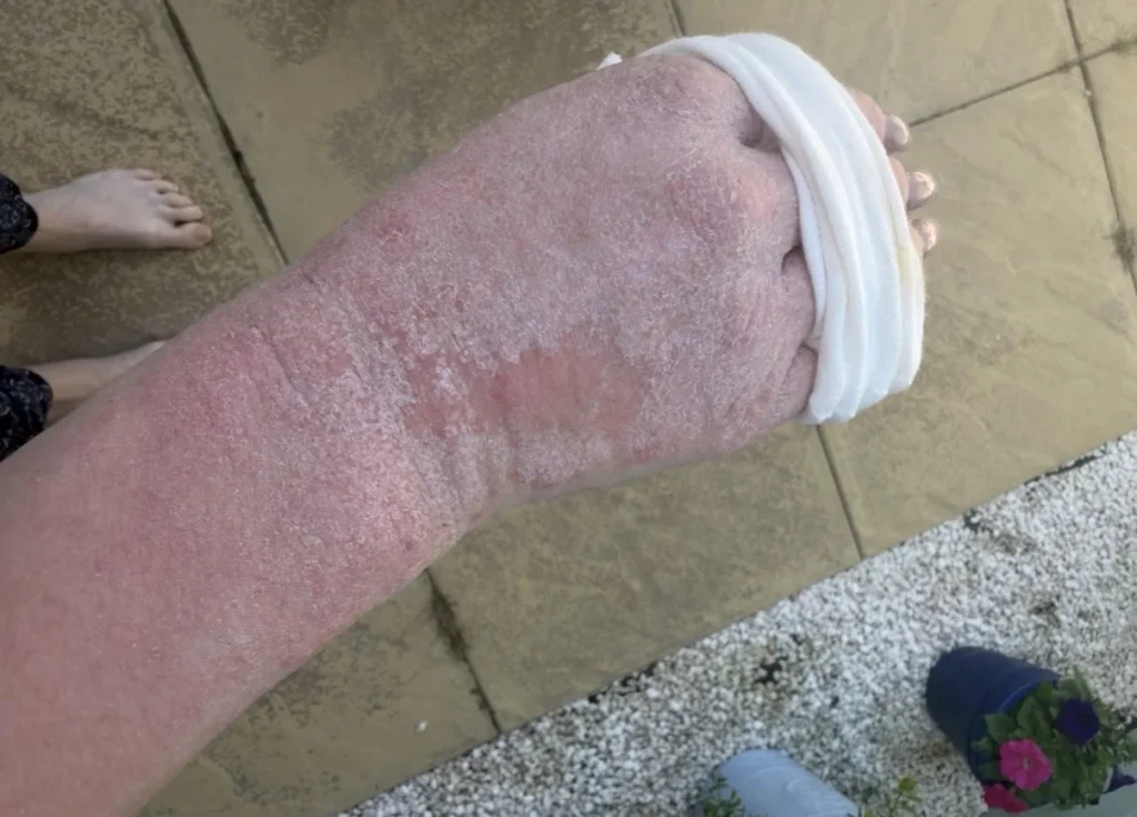 Ex on the Beach star warns of topical steroid withdrawal after spending £380k on cosmetic surgery left her severely disfigured and bedbound for weeks at a time.