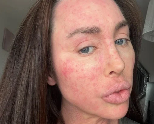 Ex on the Beach star warns of topical steroid withdrawal after spending £380k on cosmetic surgery left her severely disfigured and bedbound for weeks at a time.