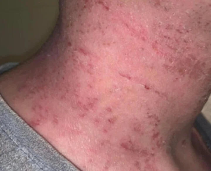 Ex on the Beach star warns of topical steroid withdrawal after spending £380k on cosmetic surgery left her severely disfigured and bedbound for weeks at a time.