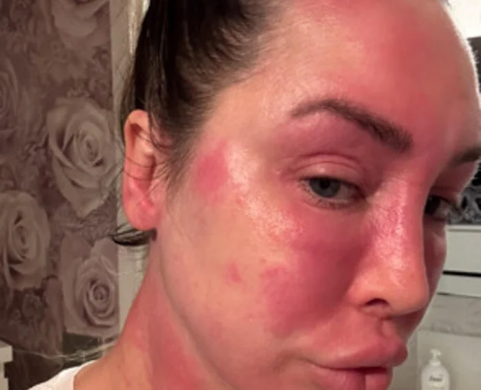 Ex on the Beach star warns of topical steroid withdrawal after spending £380k on cosmetic surgery left her severely disfigured and bedbound for weeks at a time.