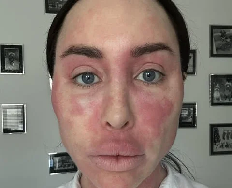Ex on the Beach star warns of topical steroid withdrawal after spending £380k on cosmetic surgery left her severely disfigured and bedbound for weeks at a time.