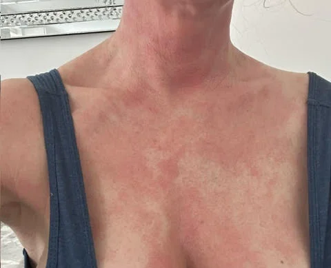 Ex on the Beach star warns of topical steroid withdrawal after spending £380k on cosmetic surgery left her severely disfigured and bedbound for weeks at a time.