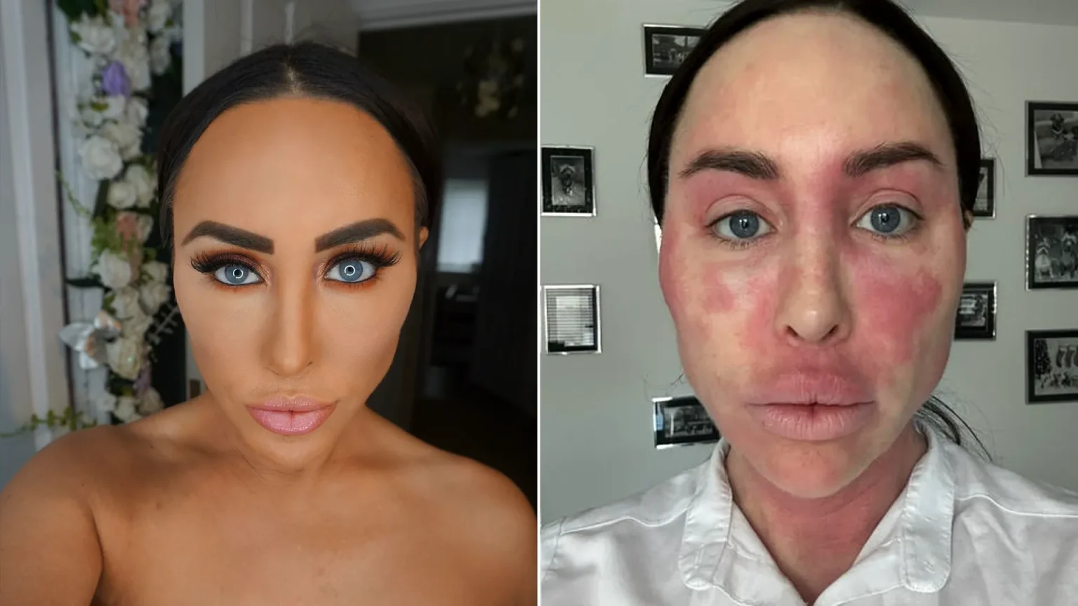 Ex on the Beach star warns of topical steroid withdrawal after spending £380k on cosmetic surgery left her severely disfigured and bedbound for weeks at a time.