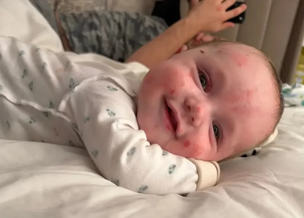 Newborn with reddened blistered skin cradled in adult's arms