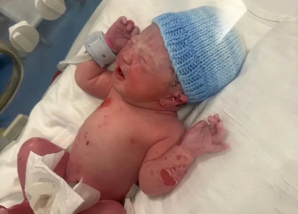 Newborn baby with severe skin blistering and redness wearing blue hat in incubator