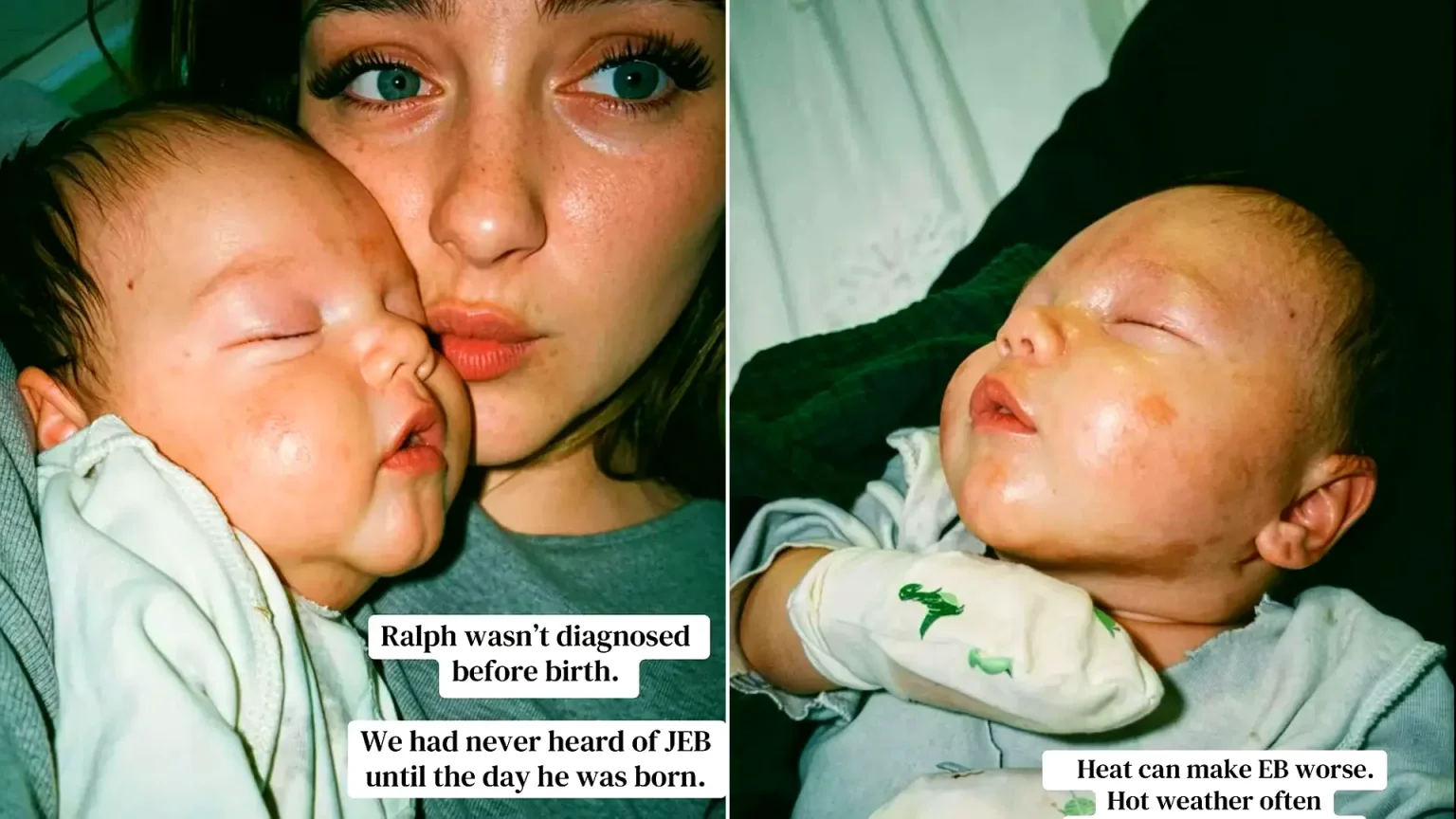 Bereaved mother holding newborn next to close-up of baby's reddened blistered skin