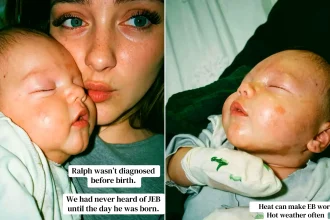 Bereaved mother holding newborn next to close-up of baby's reddened blistered skin