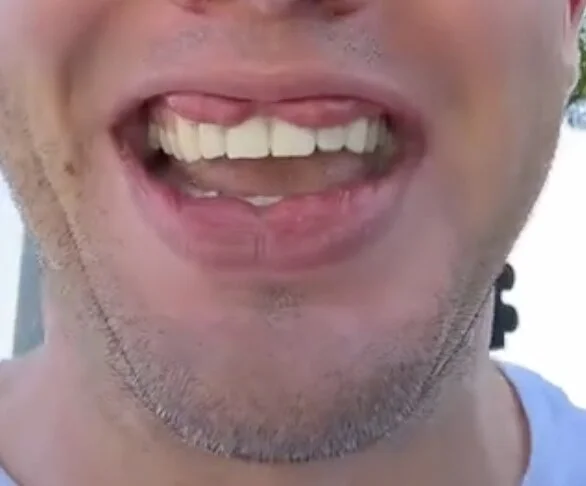 A man who has ‘double lips' has revealed the harsh nicknames he’s been called by strangers online - and is often asked if he’s using a joke filter.
