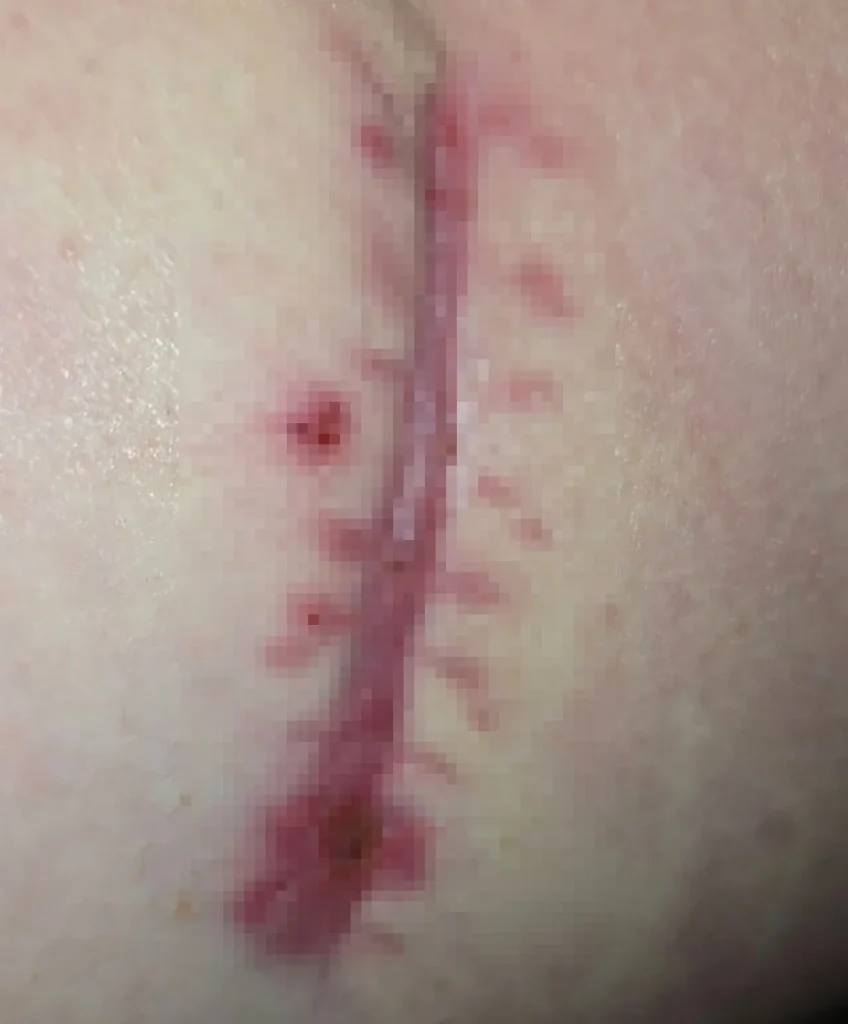 Man thought he had piles but a painful abscess turned into flesh-eating infection Fournier's gangrene, leaving him fighting for his life in intensive care with sepsis.