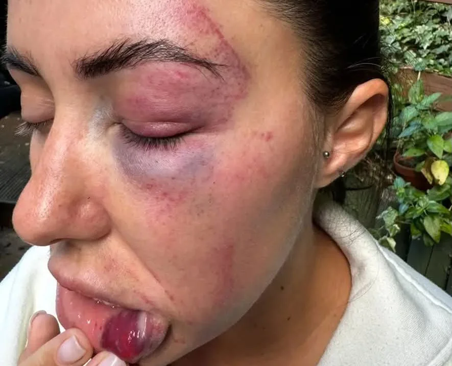 Woman's face in profile outdoors showing bruising around eye with finger near lips