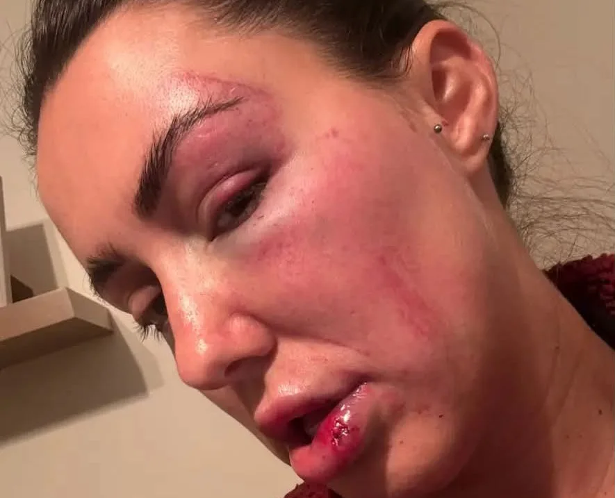 Woman's face showing severe bruising around both eyes and cheek swelling in indoor setting