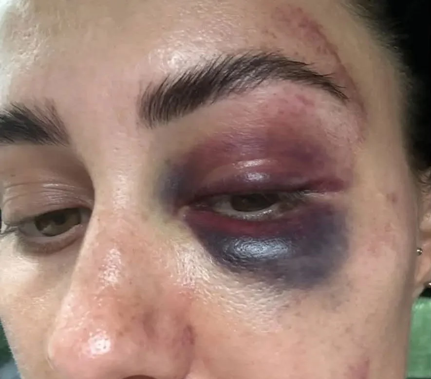 Woman's face showing severe bruising around both eyes and swelling to lips and cheeks